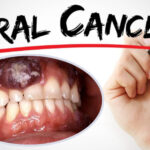 oral cancer